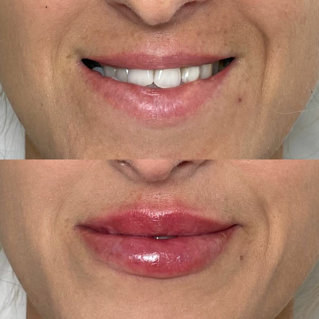 The Ultimate Guide to Achieving Plump Lips with Fillers