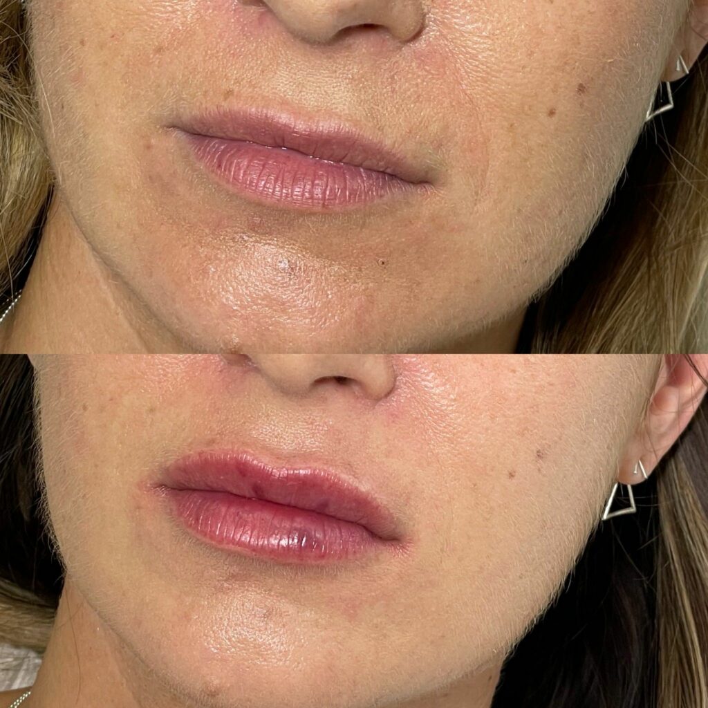 Lip filler before and after (9)