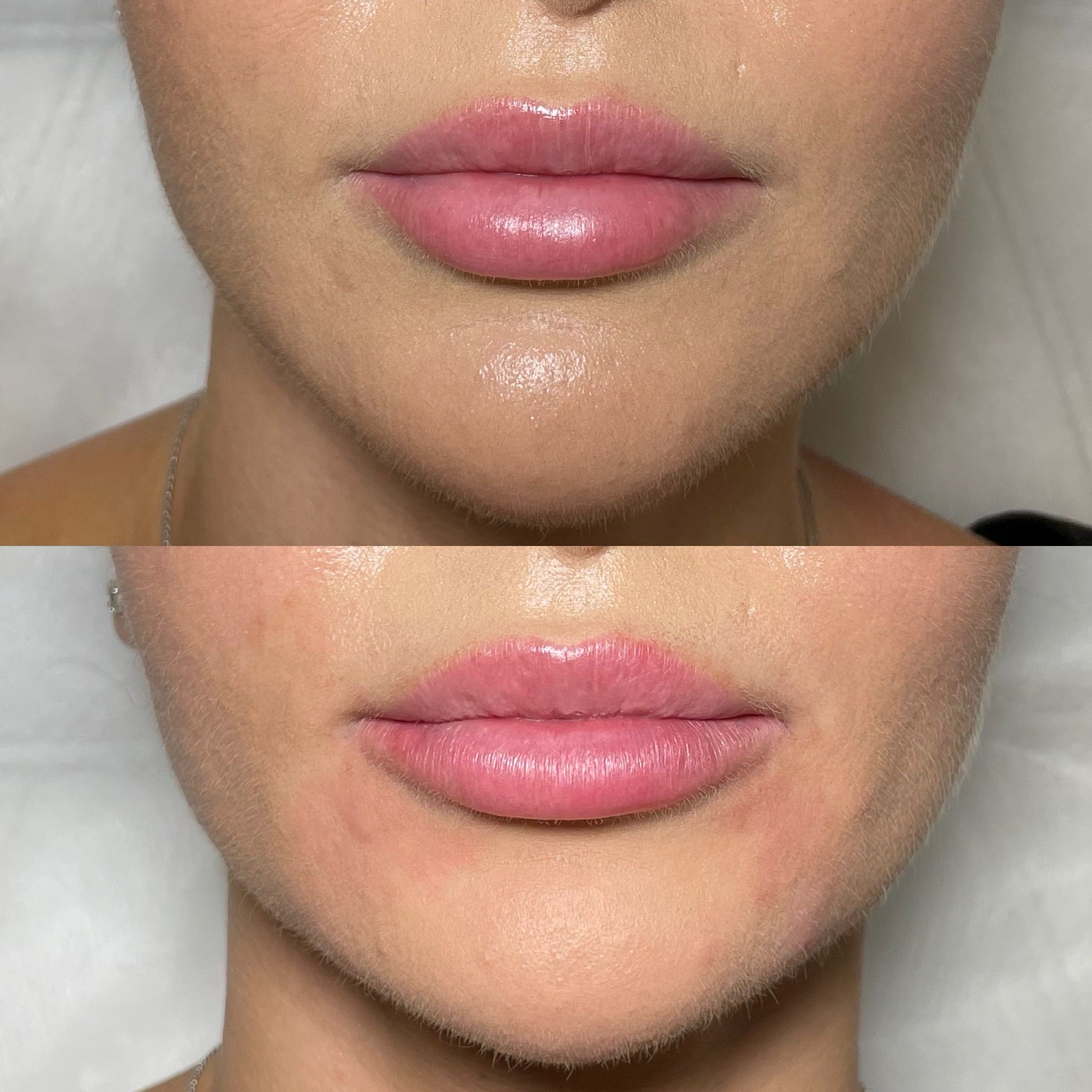 Lip Augmentation in London - Lip Filler London & Natural Lip Enhancement