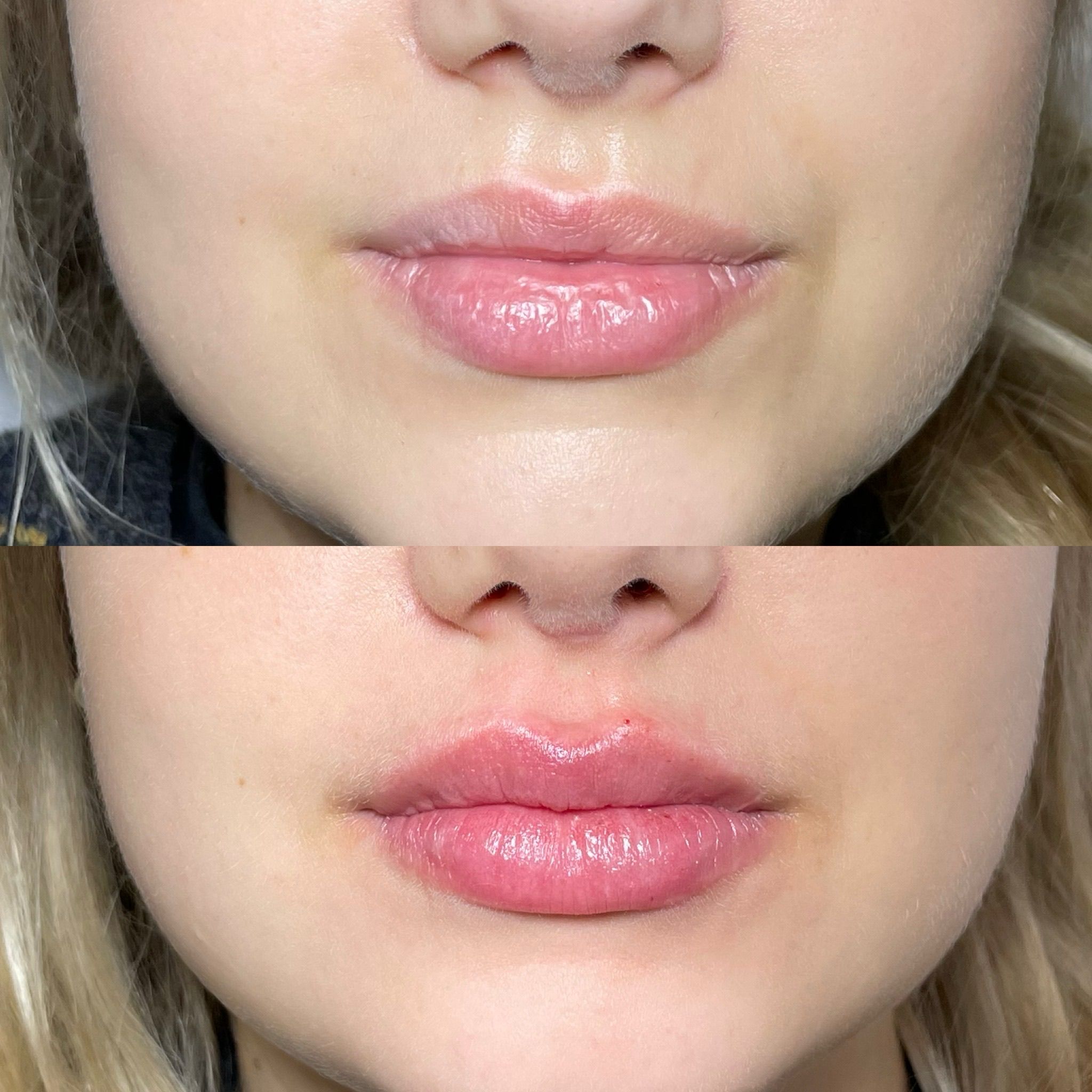 Lip Augmentation in London - Lip Filler London & Natural Lip Enhancement