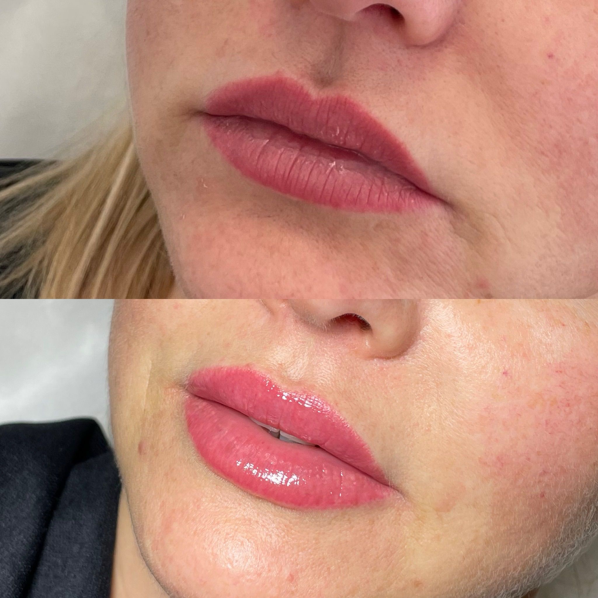 Lip Augmentation in London - Lip Filler London & Natural Lip Enhancement