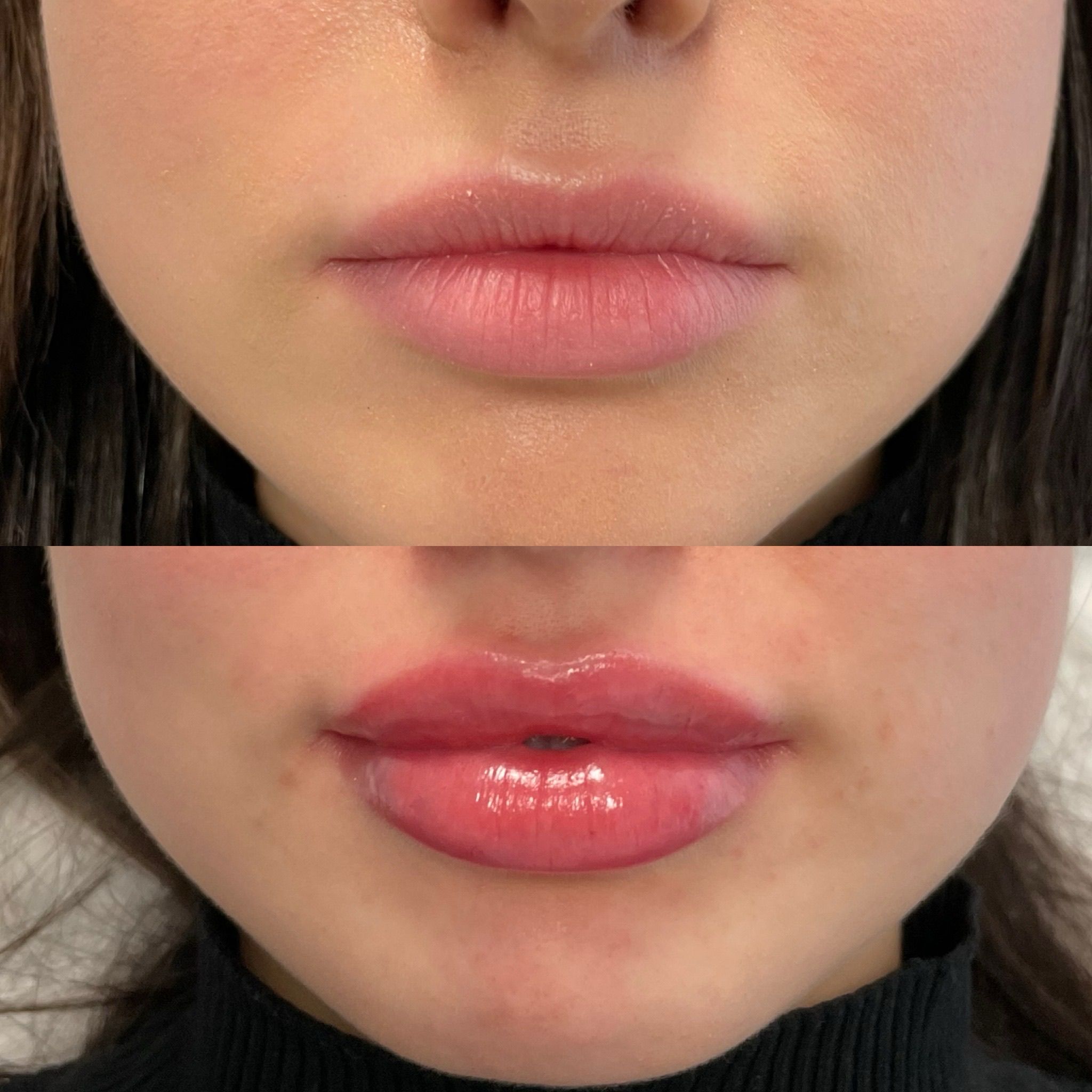 Lip Augmentation in London - Lip Filler London & Natural Lip Enhancement
