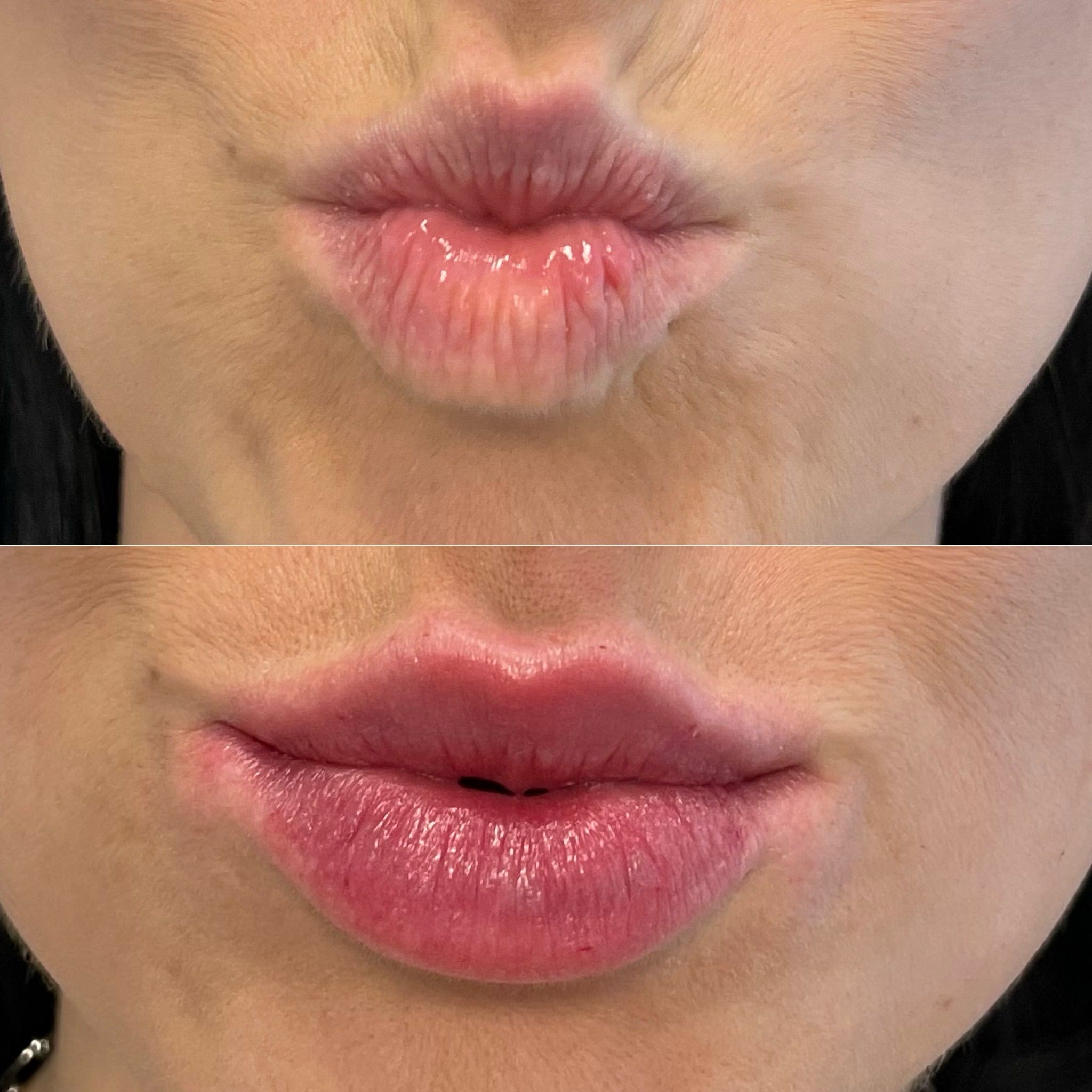 Lip Augmentation in London - Lip Filler London & Natural Lip Enhancement